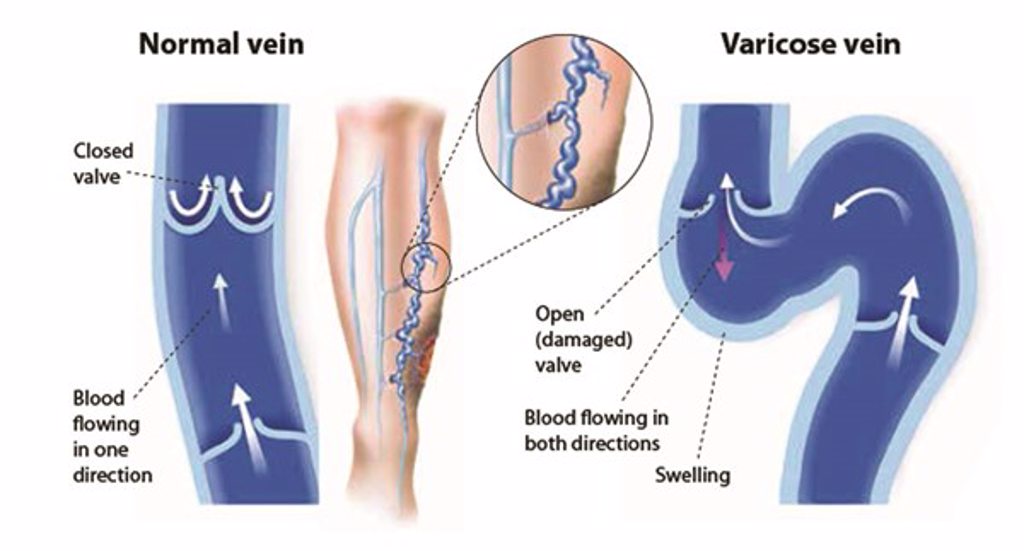 Treatment for Spider Veins & Varicose Veins - Holy Cross Medical Center